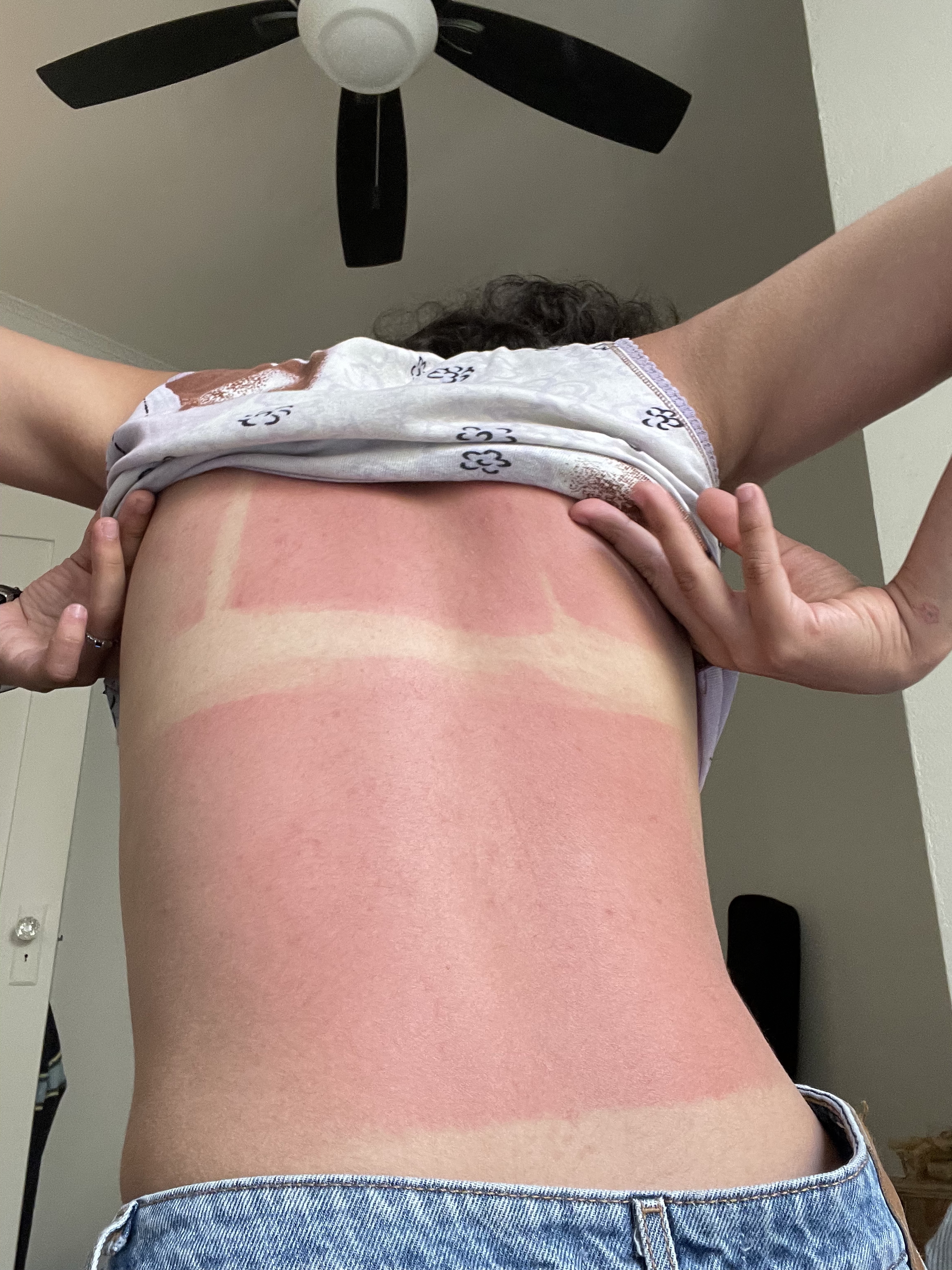 owie i got sunburnt
